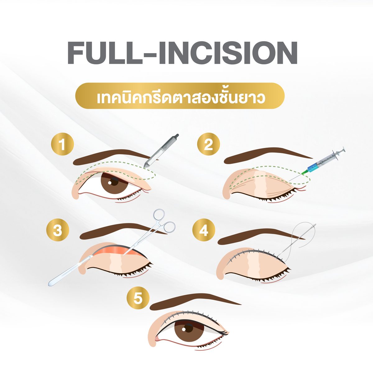 กรีดตาสองชั้น เทคนิคเย็บ (Non-incisional / Suture technique)