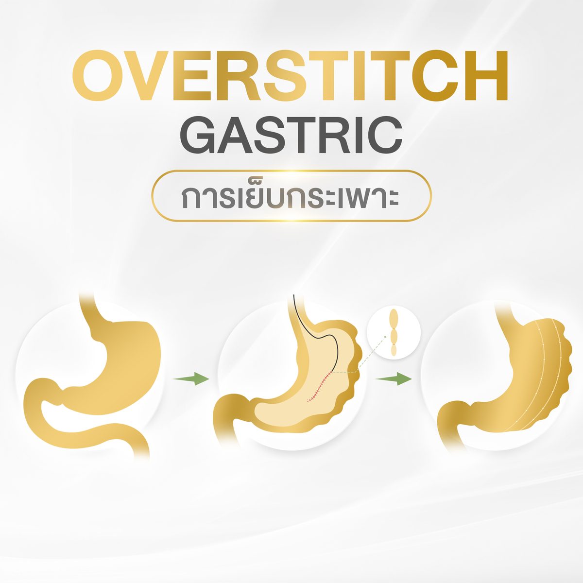 Overstitch.jpg