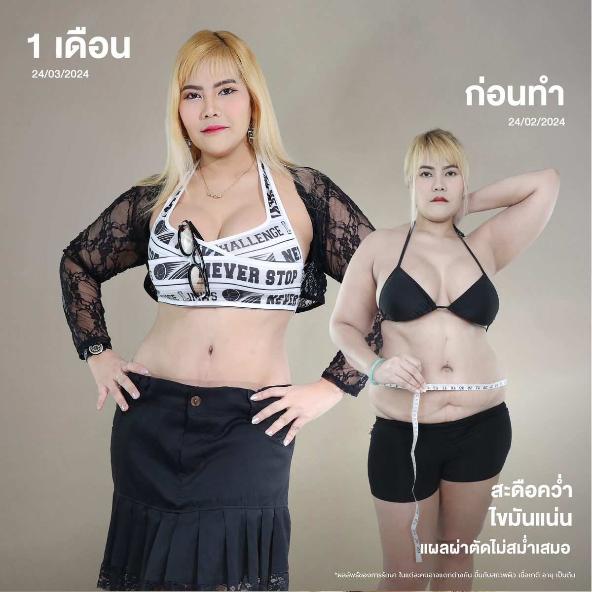 Album ทราย รัชตา กิจเจริญ ผ่าตัดหนังหน้าท้อง-02.jpg
