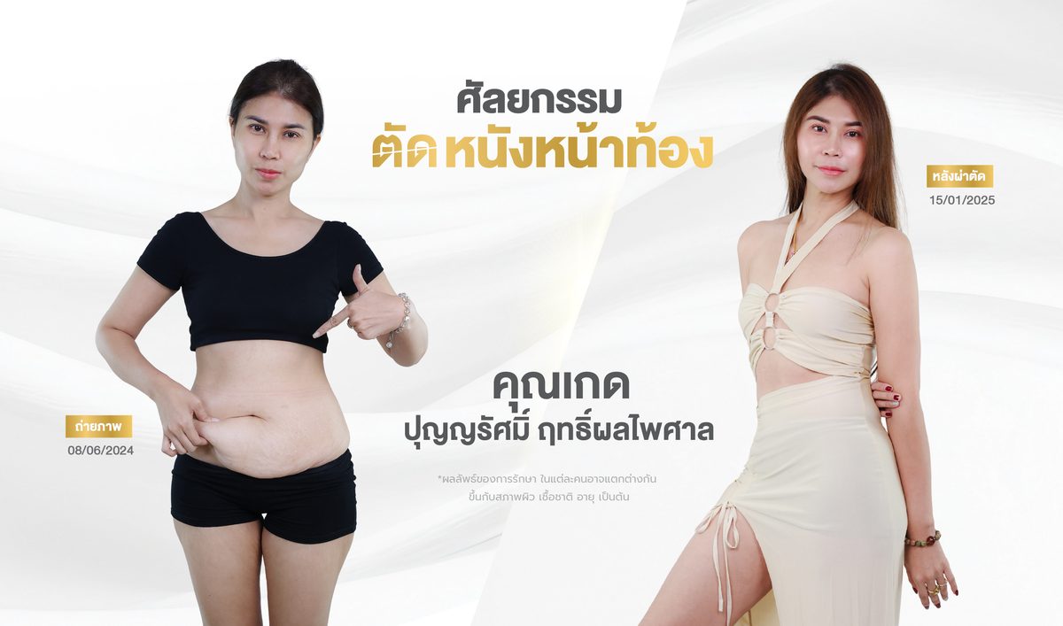ตัดหนังหน้าท้อง 3. ผลลัพธ์ที่คาดหวังได้