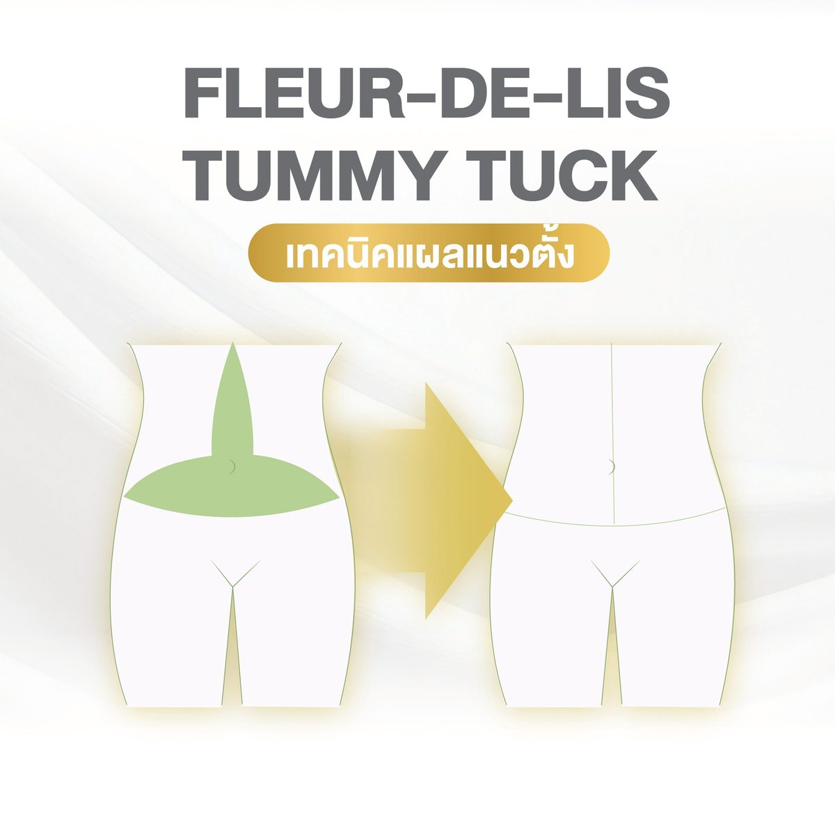 ตัดหนังหน้าท้อง 5) เทคนิคแผลแนวตั้ง (Fleur-de-lis Tummy Tuck)