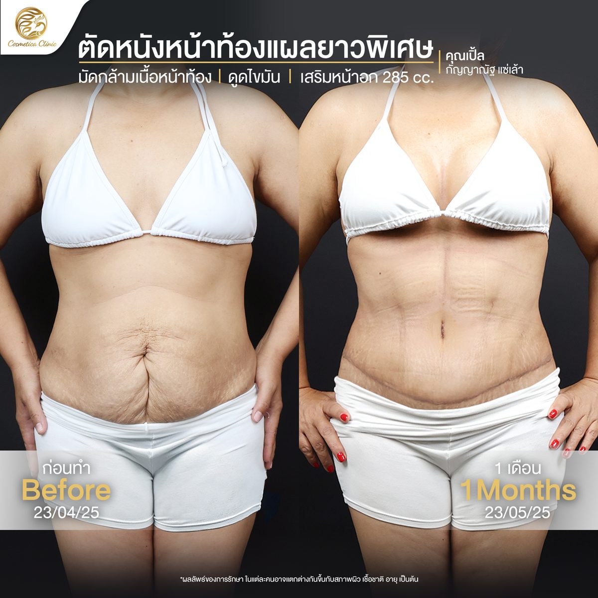 Review--ตัดหนังหน้าท้อง-(เปิ้ล-กัญญาณัฐ-แซ่เล้า).jpg