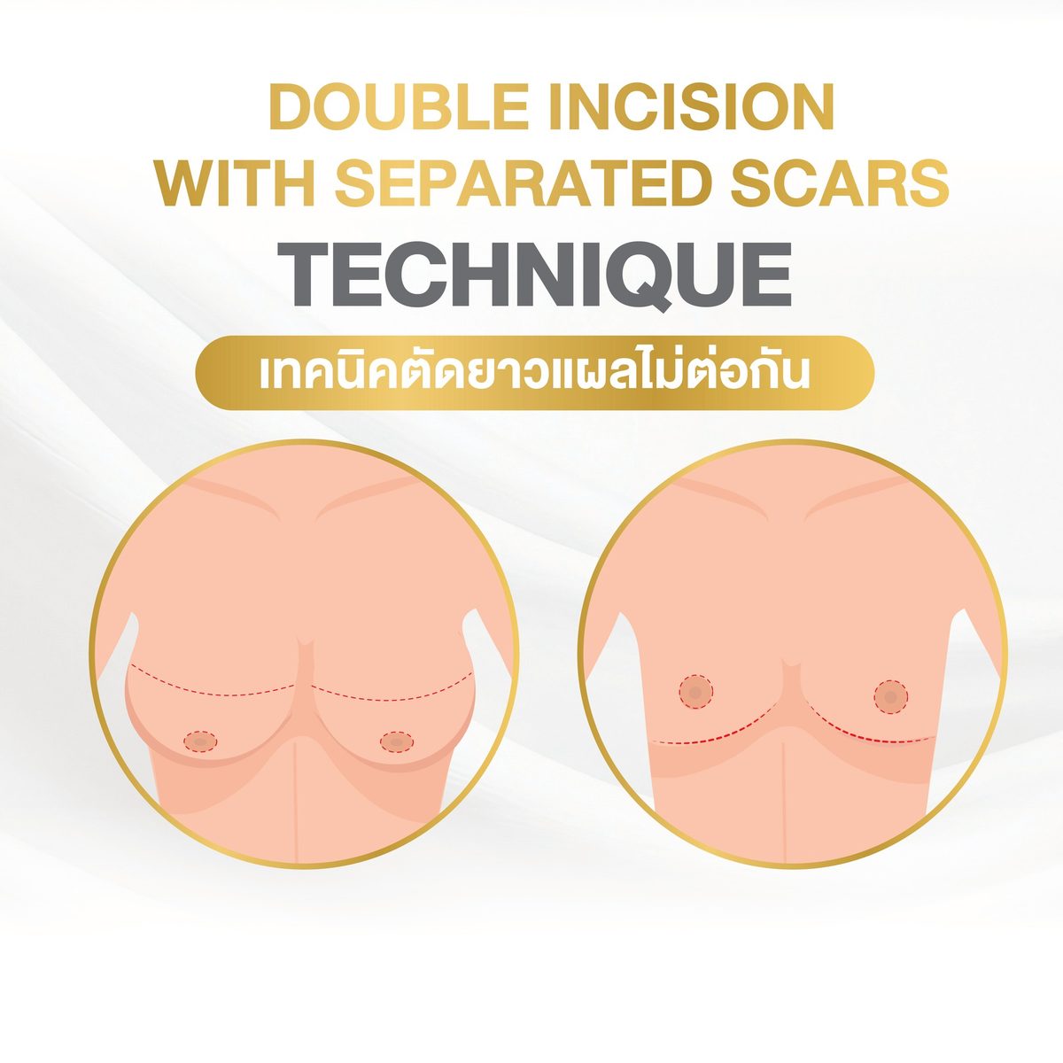 ตัดหน้าอก 2. รูปแบบเทคนิคแผล