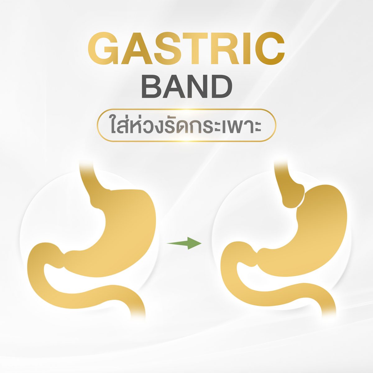 gastricband.jpg