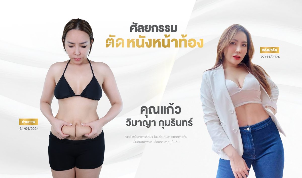 ตัดหนังหน้าท้อง 3. ผลลัพธ์ที่คาดหวังได้