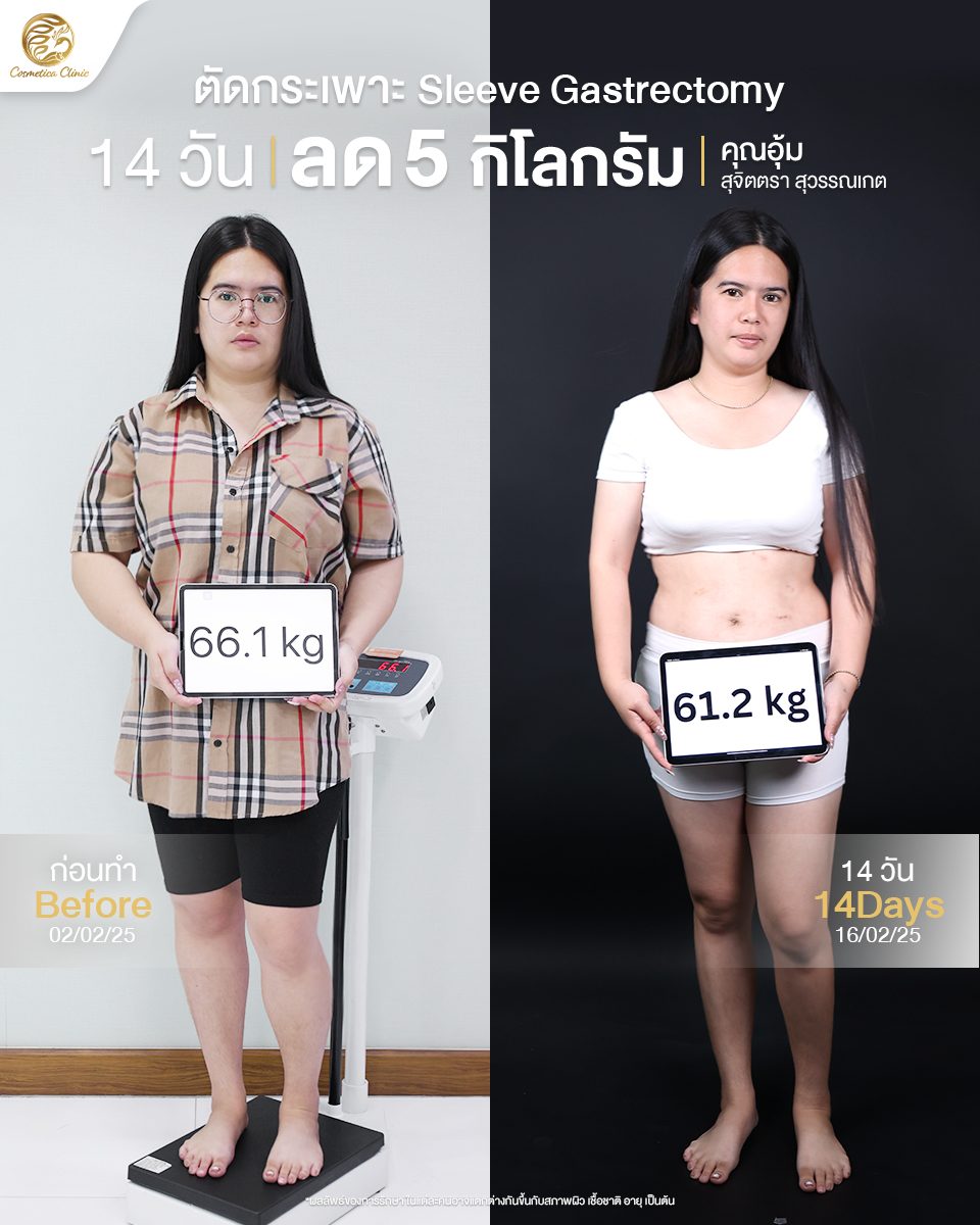 ตัดกระเพาะ-Sleeve-gastrectomy(อุ้ม-สุจิตตรา-สุวรรณเกต)_0.jpg