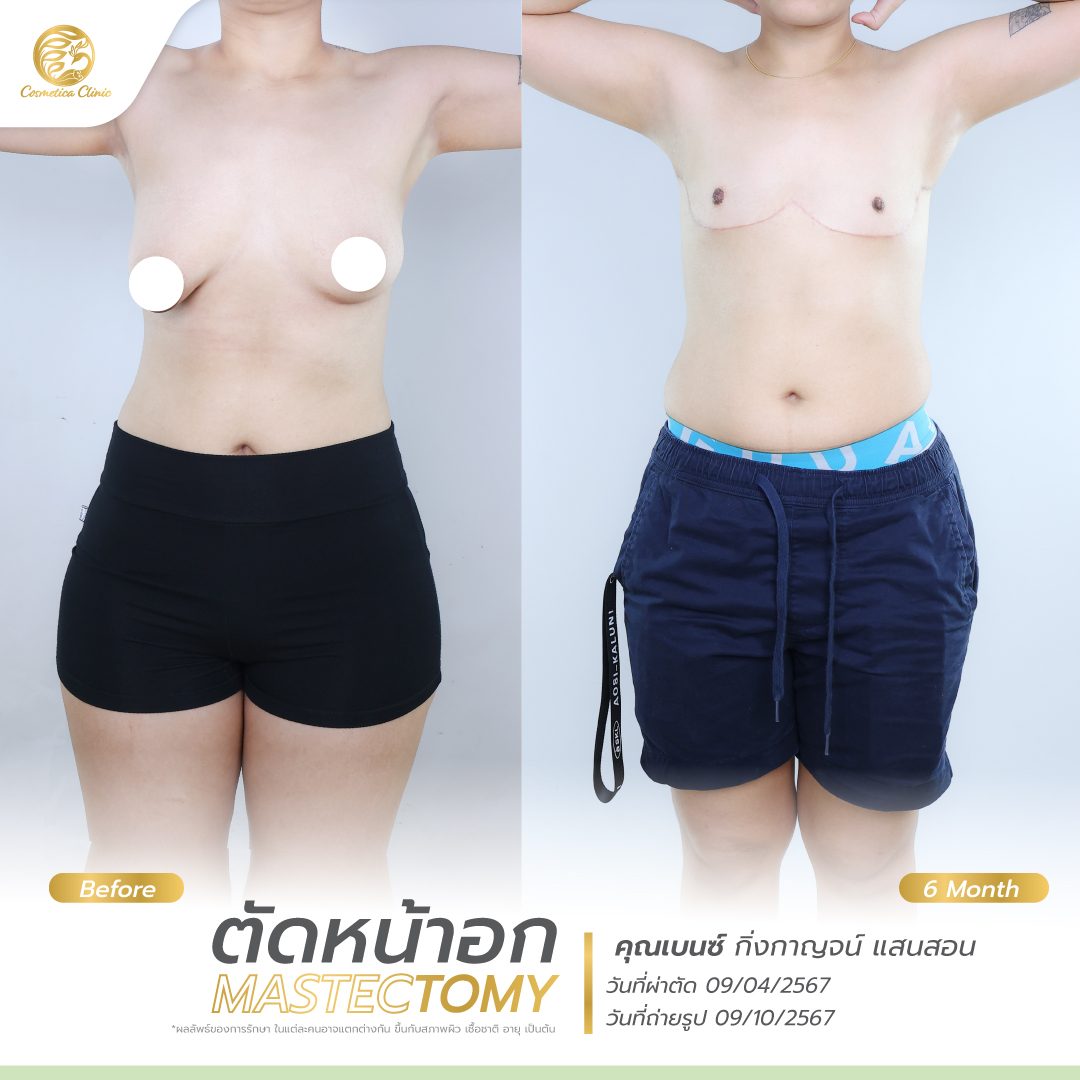 BF-AT-เบนซ์-กิ่งกาญจน์-แสนสอน-ตัดหน้าอก.jpg
