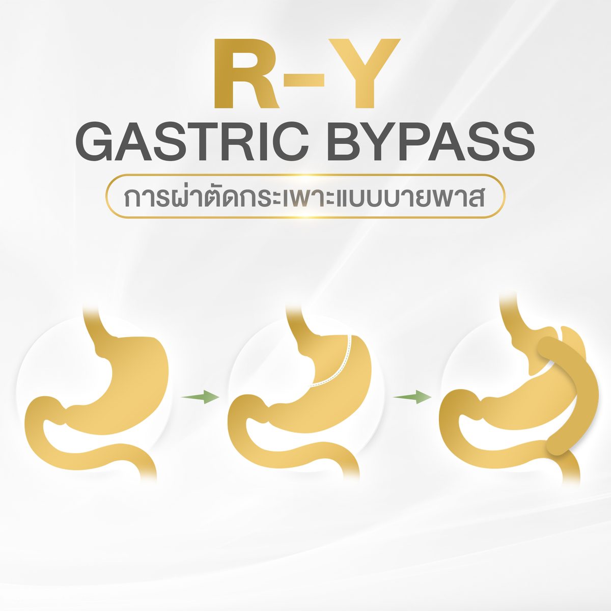 gastricbypass.jpg