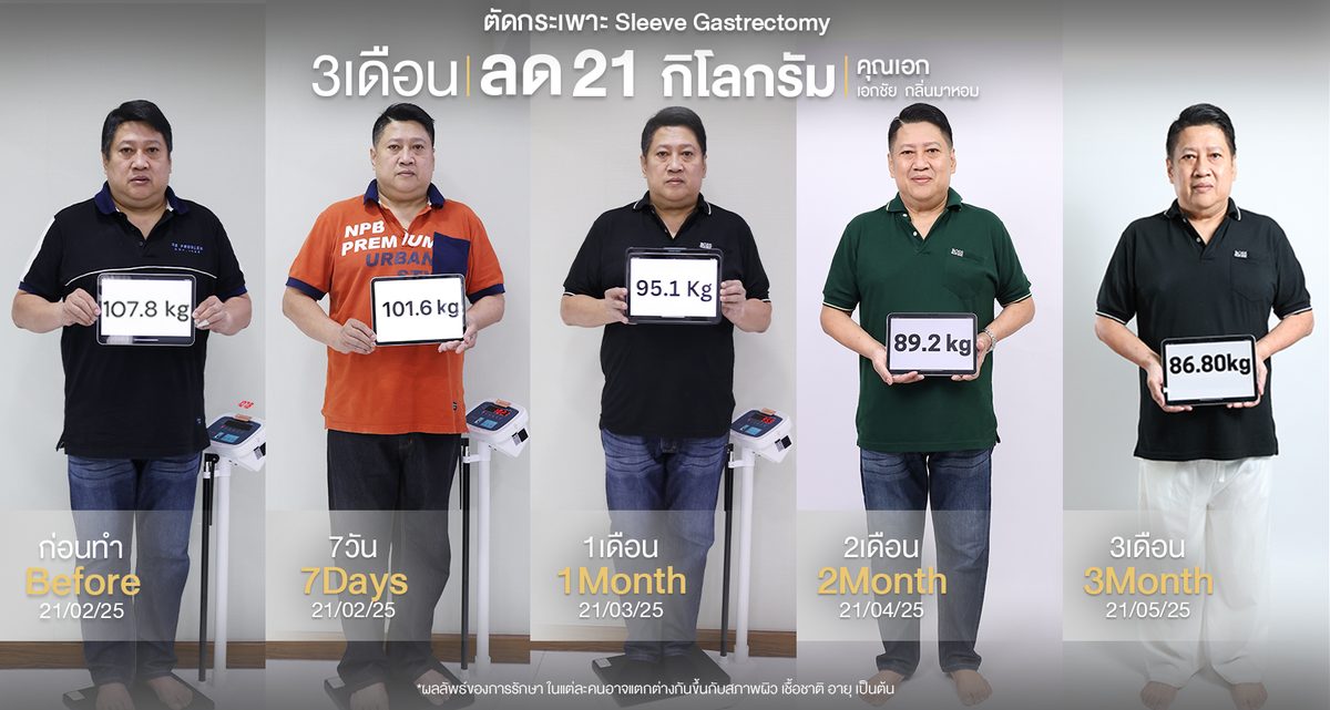 ตัดกระเพาะ-Sleeve-gastrectomy(เอก-เอกชัย)Web_0.jpg