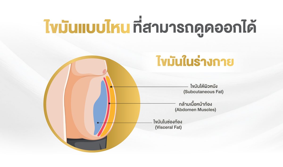 Website---ไขมันแบบไหนที่สามารถดูดออกได้.jpg