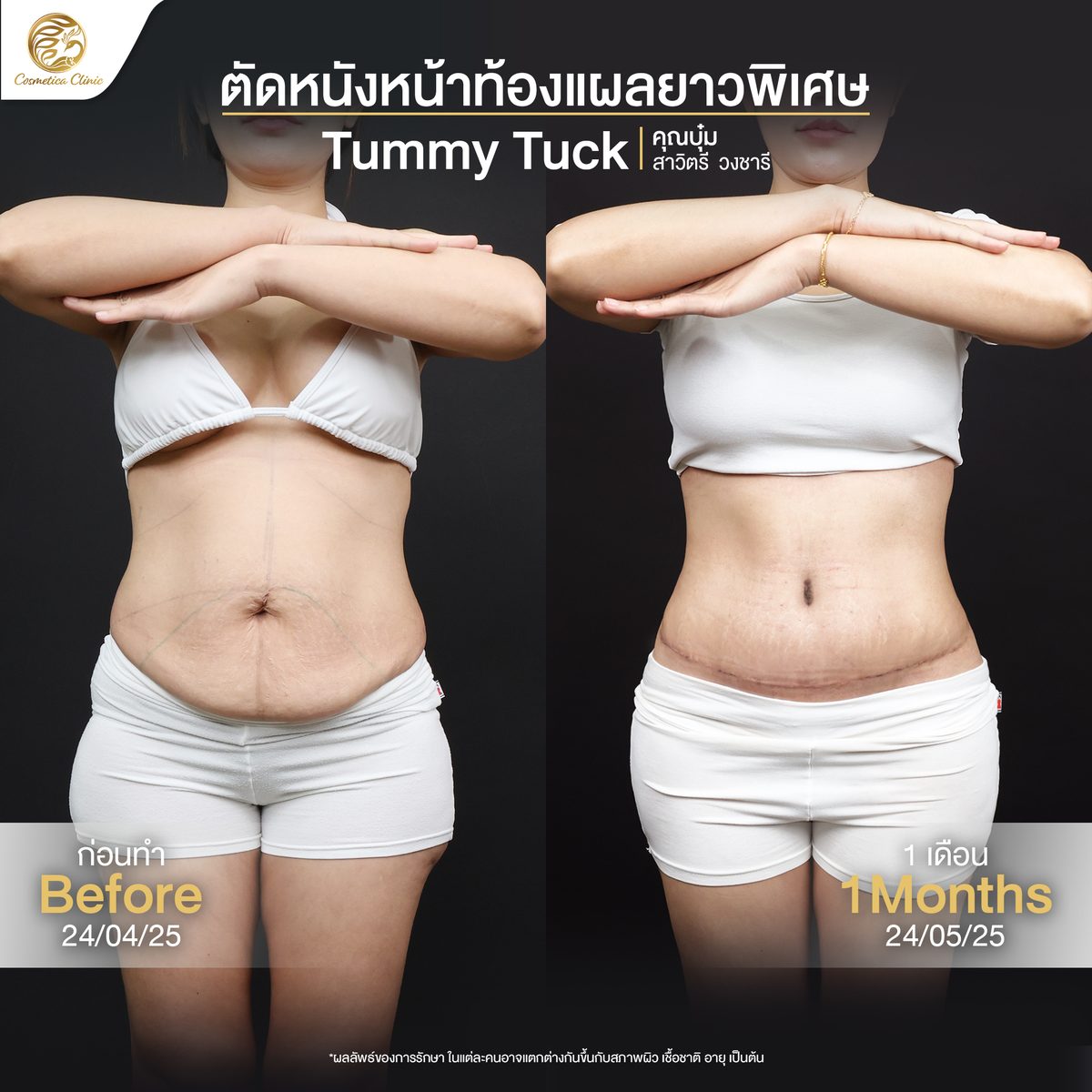 Review--ตัดหนังหน้าท้อง-(บุ๋ม-สาวิตรี-วงชารี).jpg