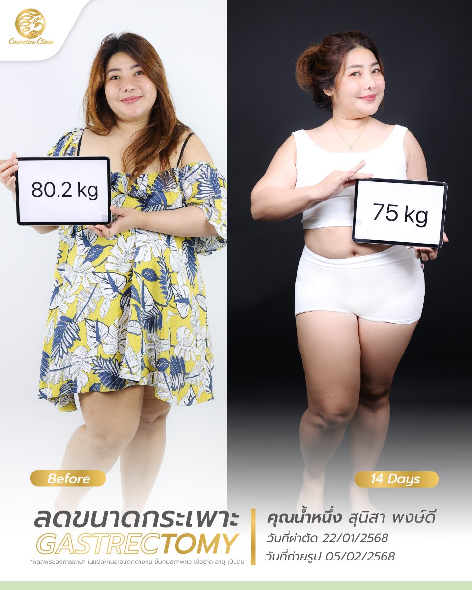 BF-AT-น้ำหนึ่ง-สุนิสา-พงษ์ดี-ตัดกระเพาะ-2.jpg