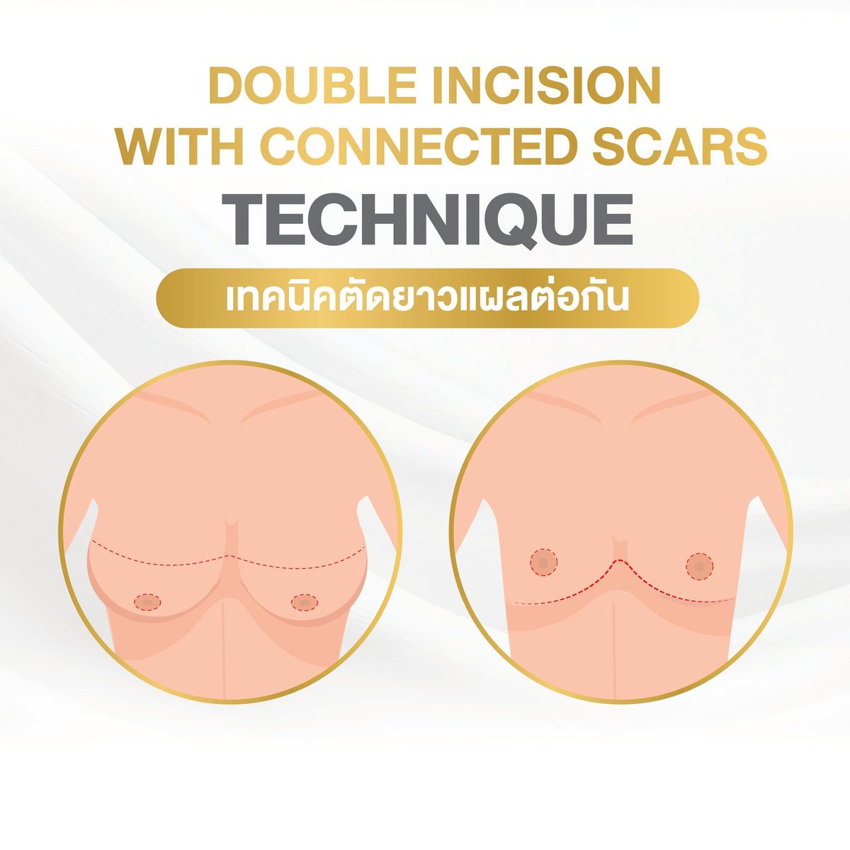 ตัดหน้าอก 2. รูปแบบเทคนิคแผล