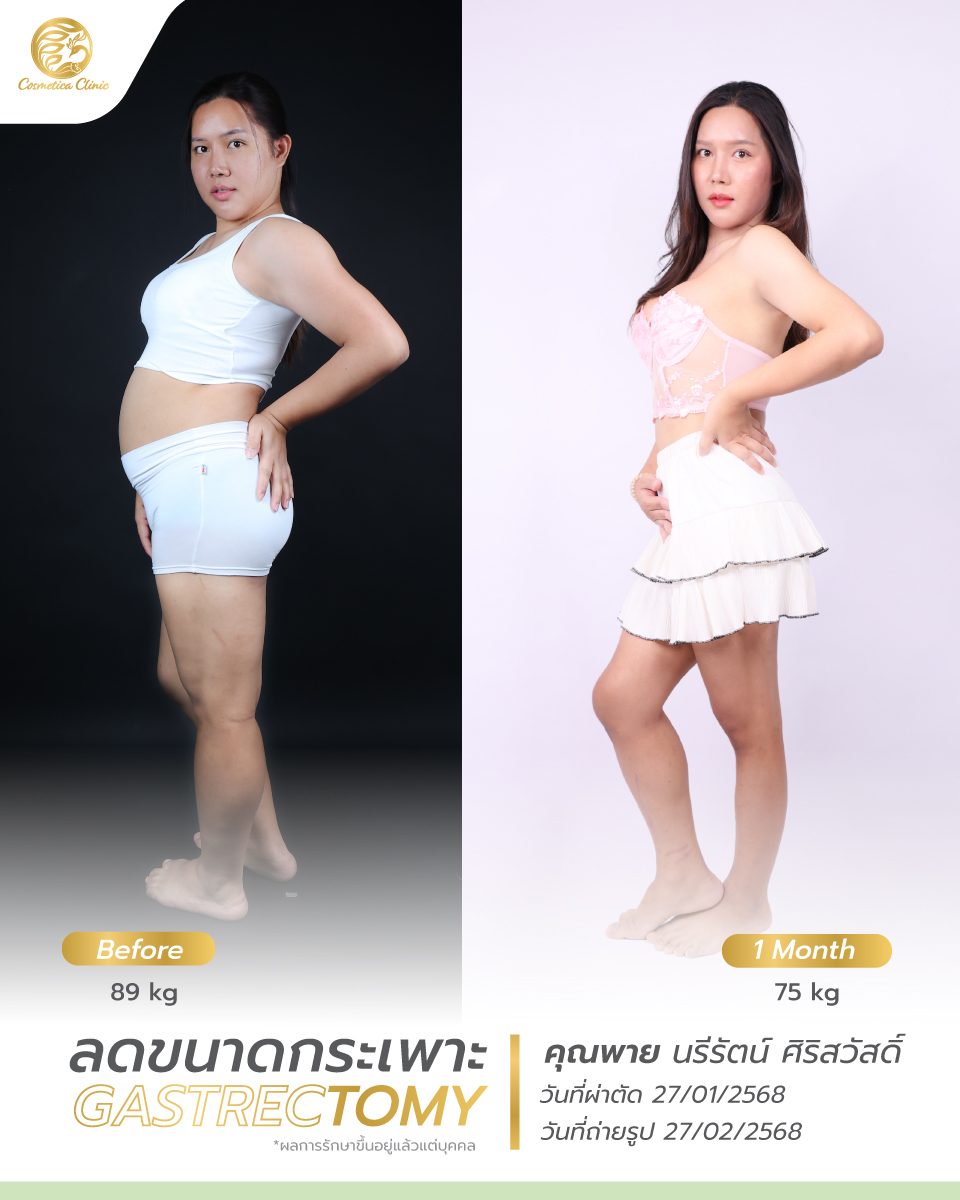 BF-AT-พาย-นรีรัตน์-ตัดกระเพาะ-2-4-5.jpg