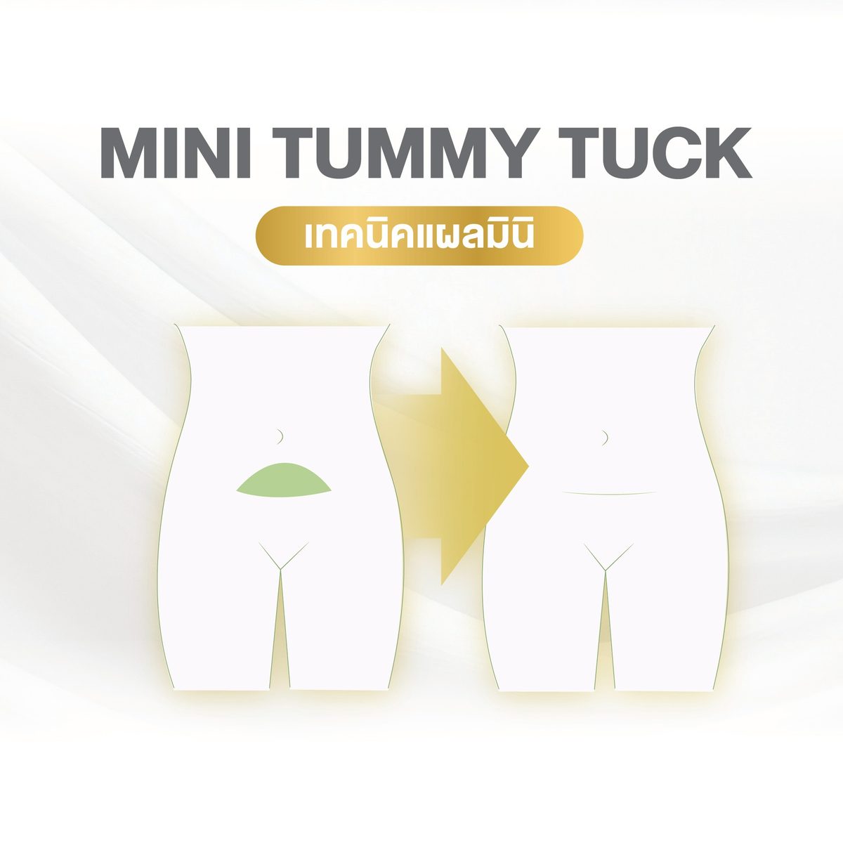 Website - info 5 เทคนิค Tummy Tuck-01.jpg