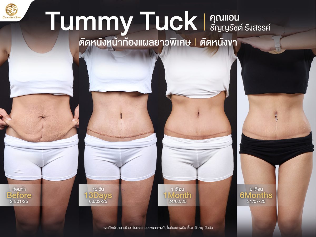 Review--ตัดหนังหน้าท้อง-(แอน-ชัญญรัชต์).jpg