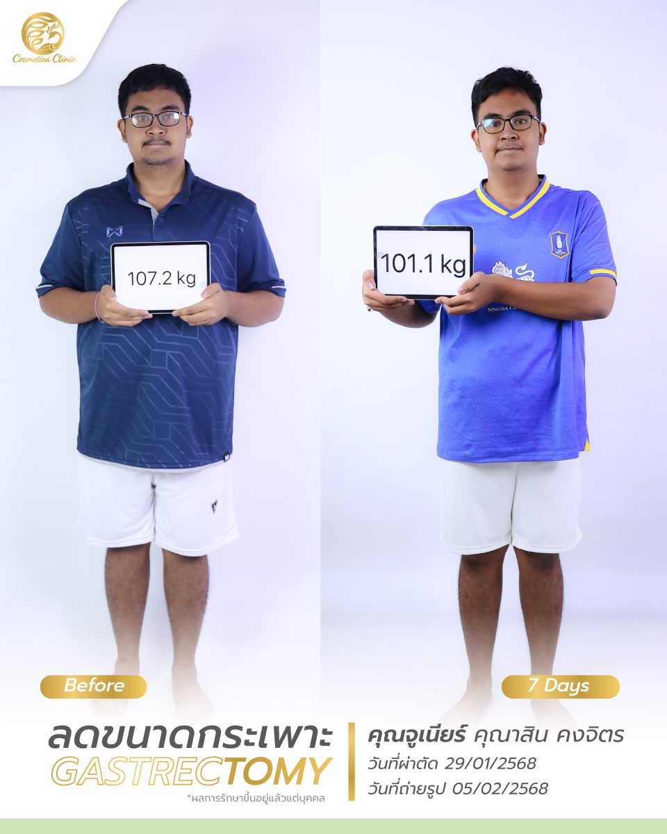BF-AT--จูเนียร์-คุณาสิน-คงจิตร-ตัดกระเพาะ-7day-4-5.jpg