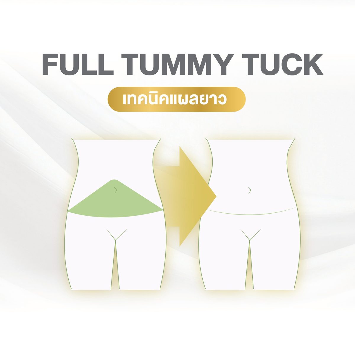 ตัดหนังหน้าท้อง 2) เทคนิคแผลยาว (Full Tummy Tuck)