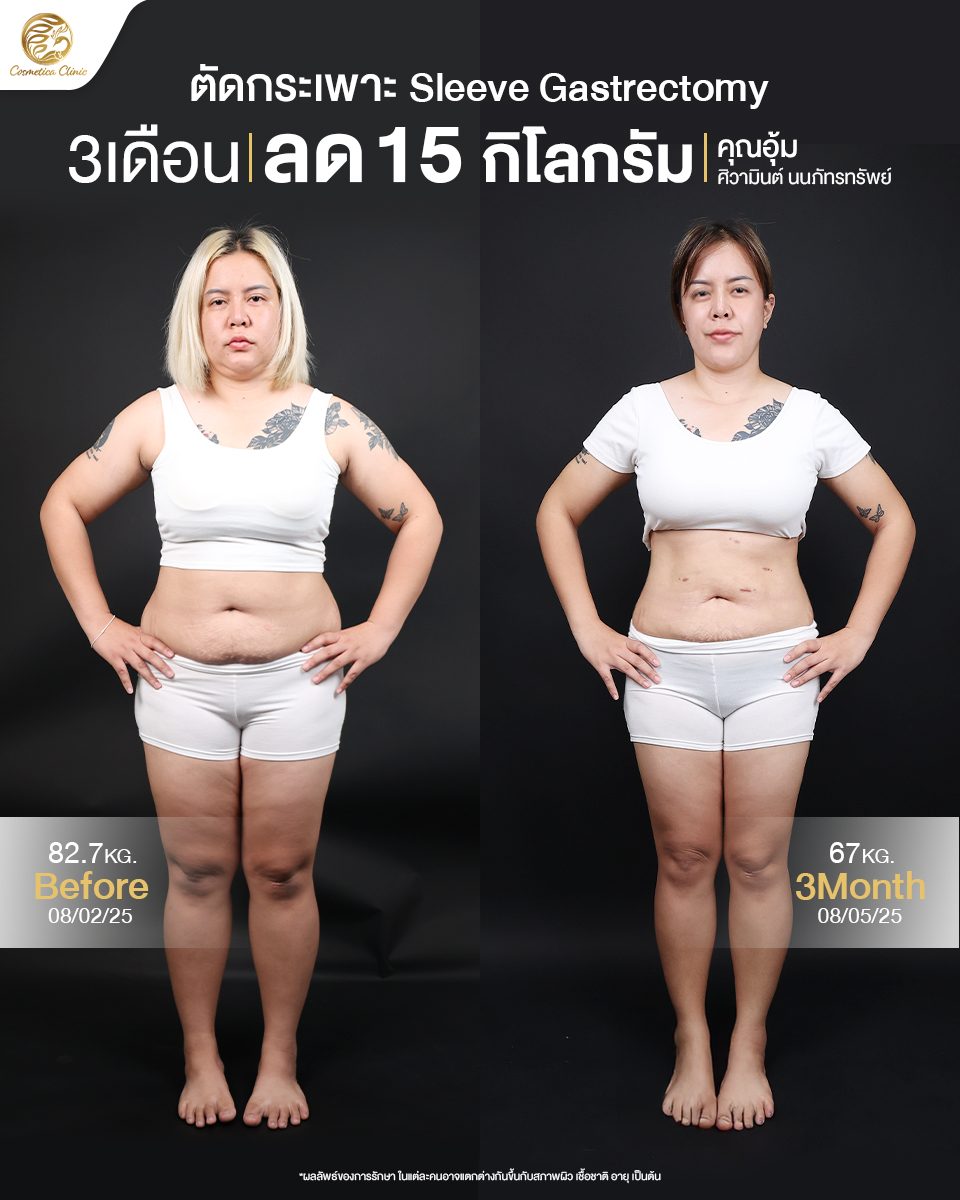 ตัดกระเพาะ-Sleeve-gastrectomy(อุ้ม-ศิวามินต์-นนภัทรทรัพย์)2.jpg