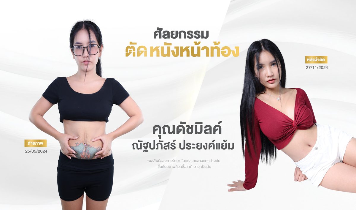 ตัดหนังหน้าท้อง 3. ผลลัพธ์ที่คาดหวังได้